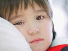 Làm gì để không bị đau mắt đỏ?